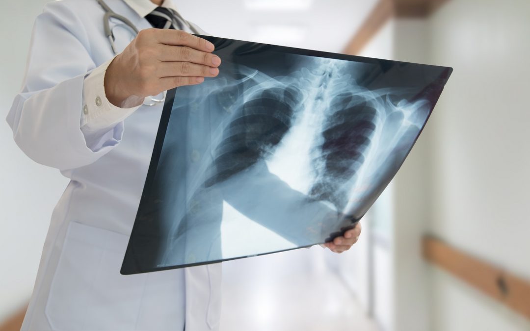 Changes to chest x-ray requests for Ipswich and Colchester Hospital